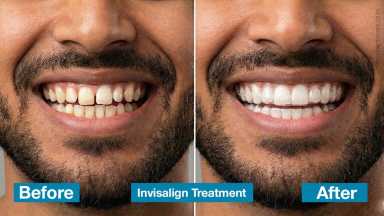 Invisalign.jpg (1)