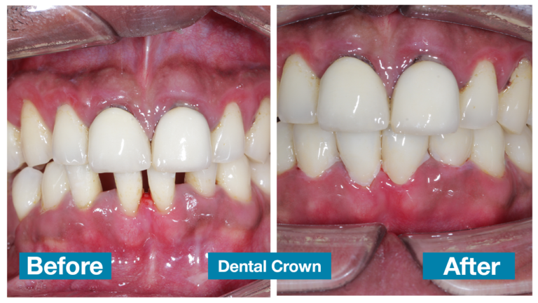Dental crown 1