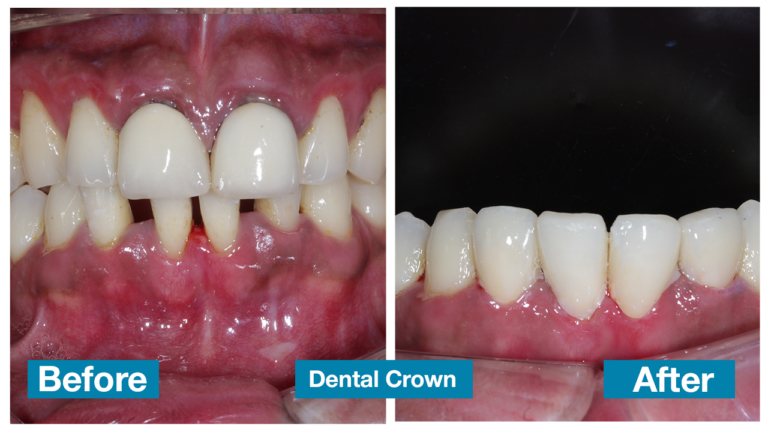 Dental crown 2