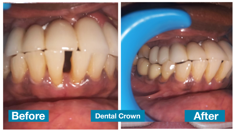 Dental crown 3