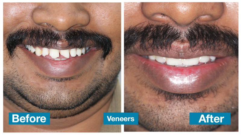Veneers 1