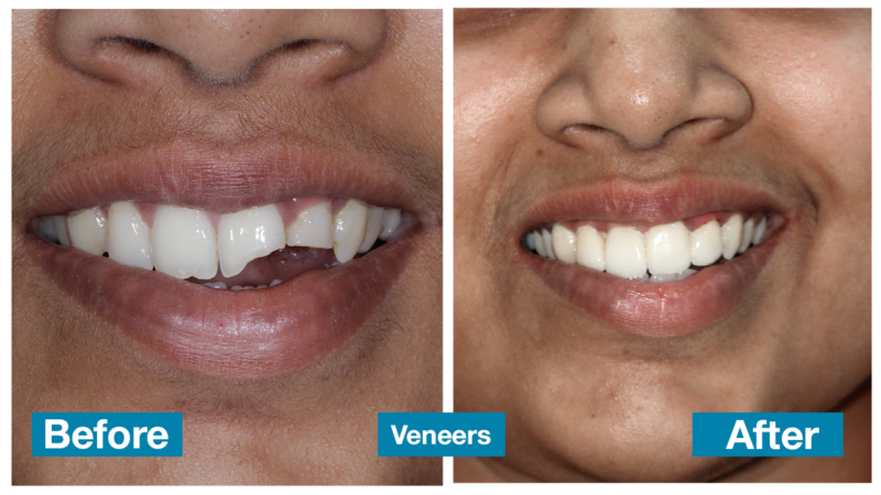 Veneers 2