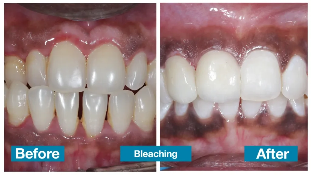 Professional dental treatment in Chennai