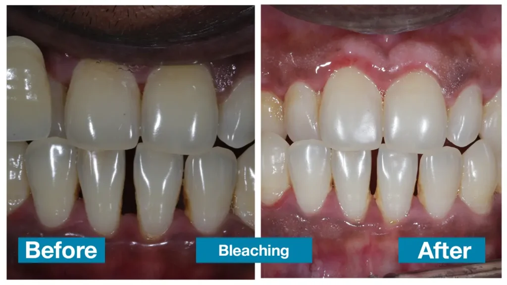Dental Treatment in Chennai
