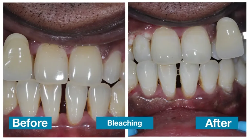 Smile Makeover in Chennai