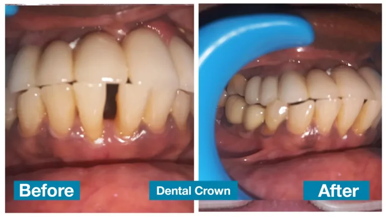 Dental implant treatment in Chennai