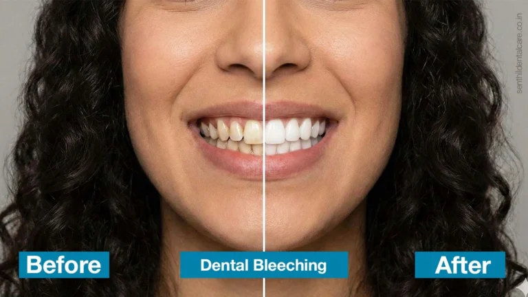 Dentalbleeching in chennai
