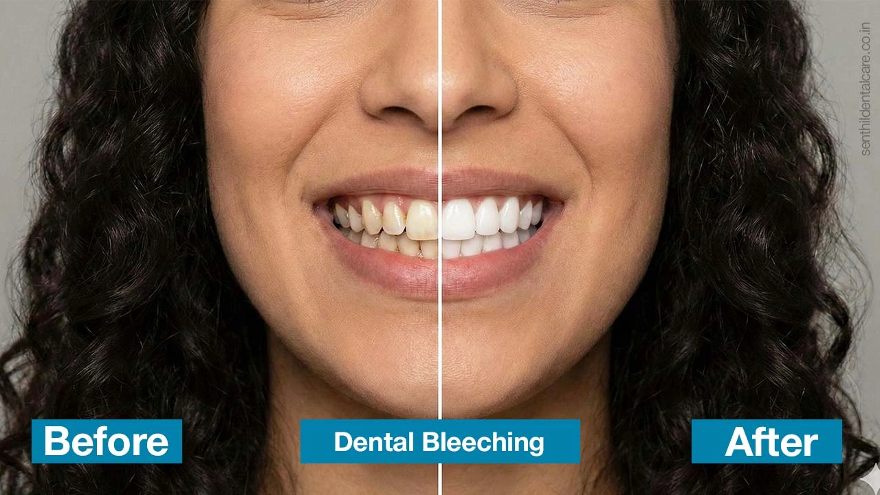 Dentalbleeching in chennai