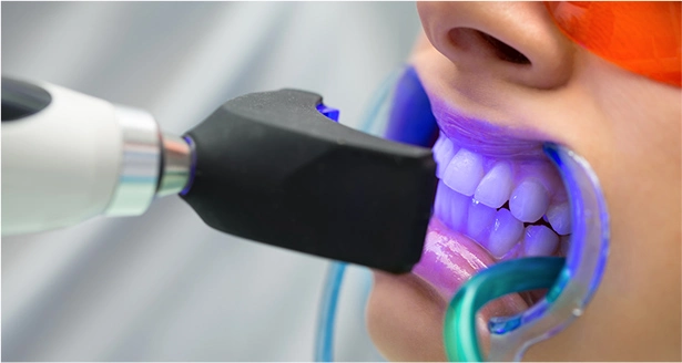 Professional Teeth Whitening in Chennai