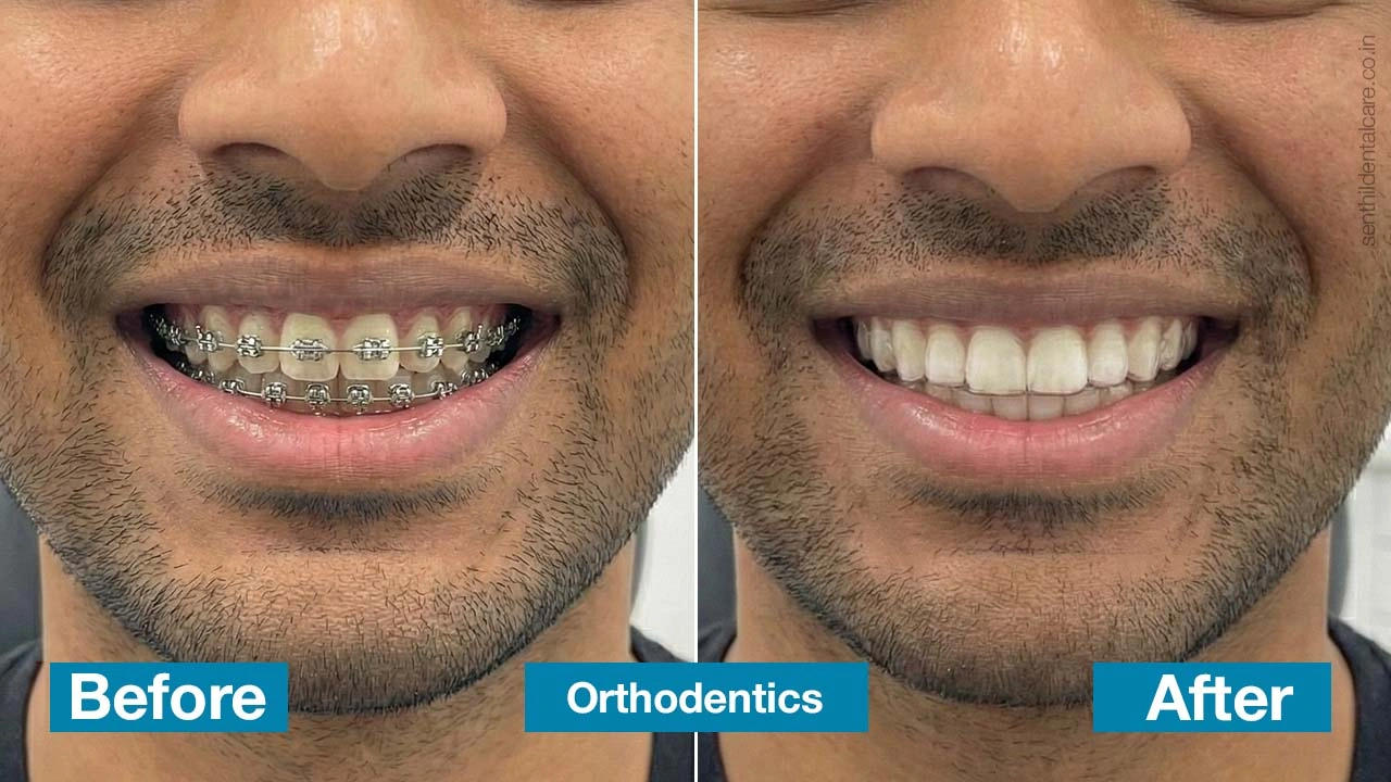 Ortho dentics in chennai