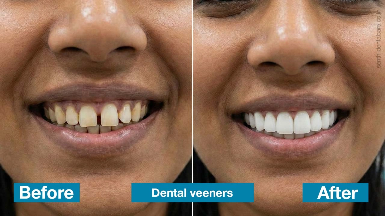 Dental Veeners in chennai