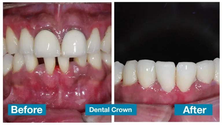 Professional teeth whitening treatment in Chennai