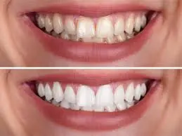 Close up view of clean healthy white teeth after dental aesthetics treatment